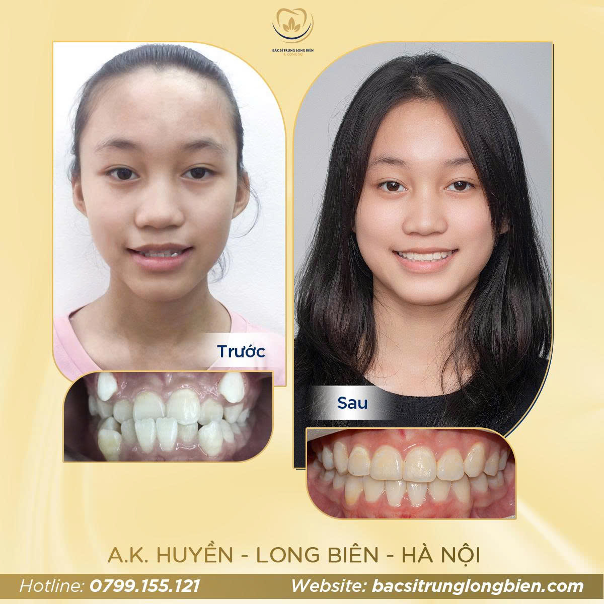 Khách hàng A.K Huyền - Nha khoa Bác sĩ Trung Long Biên