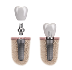 Implant1rang 1 - Nha khoa Bác sĩ Trung Long Biên