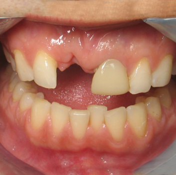 Tình trạng mất răng – Nên trồng Implant hay làm cầu răng? - Nha khoa Bác sĩ Trung Long Biên