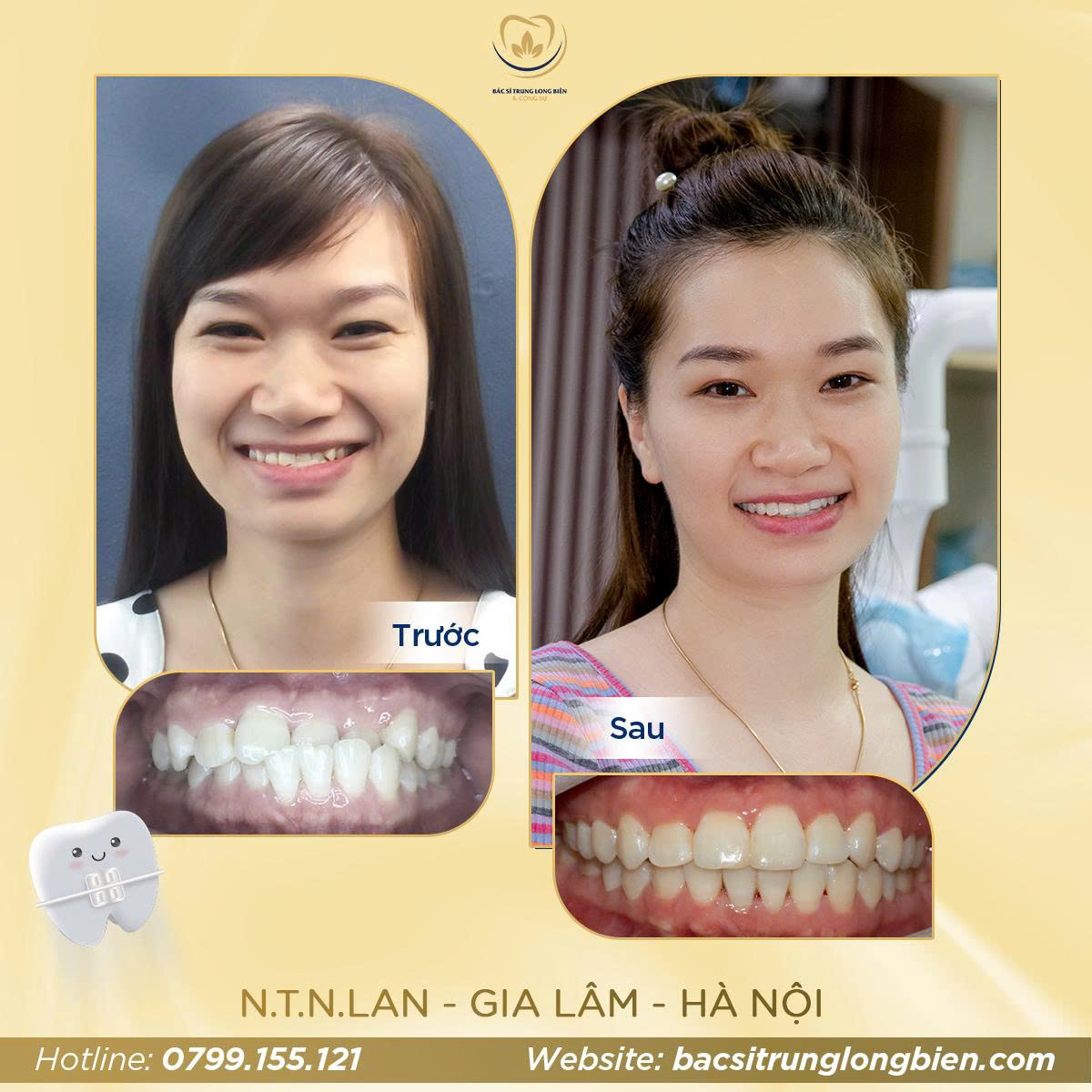 Khách Hàng N.T.N Lan - Nha khoa Bác sĩ Trung Long Biên