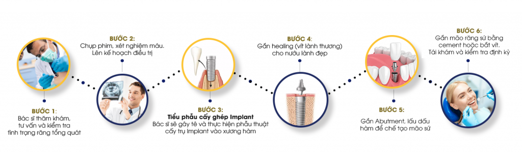 quy Trinh cấy ghép Implant Final 2 - Nha khoa Bác sĩ Trung Long Biên