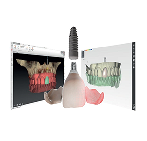 Digital cấy ghép Implant la gi 2 - Nha khoa Bác sĩ Trung Long Biên