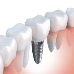 Trồng răng Implant là gì? Trường hợp nên trồng và ưu điểm