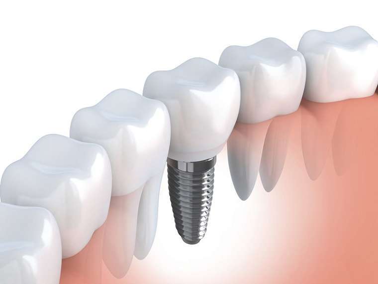 Trường hợp nào nên cấy Implant – Nếu không cấy có ảnh hưởng gì? - Nha khoa Bác sĩ Trung Long Biên
