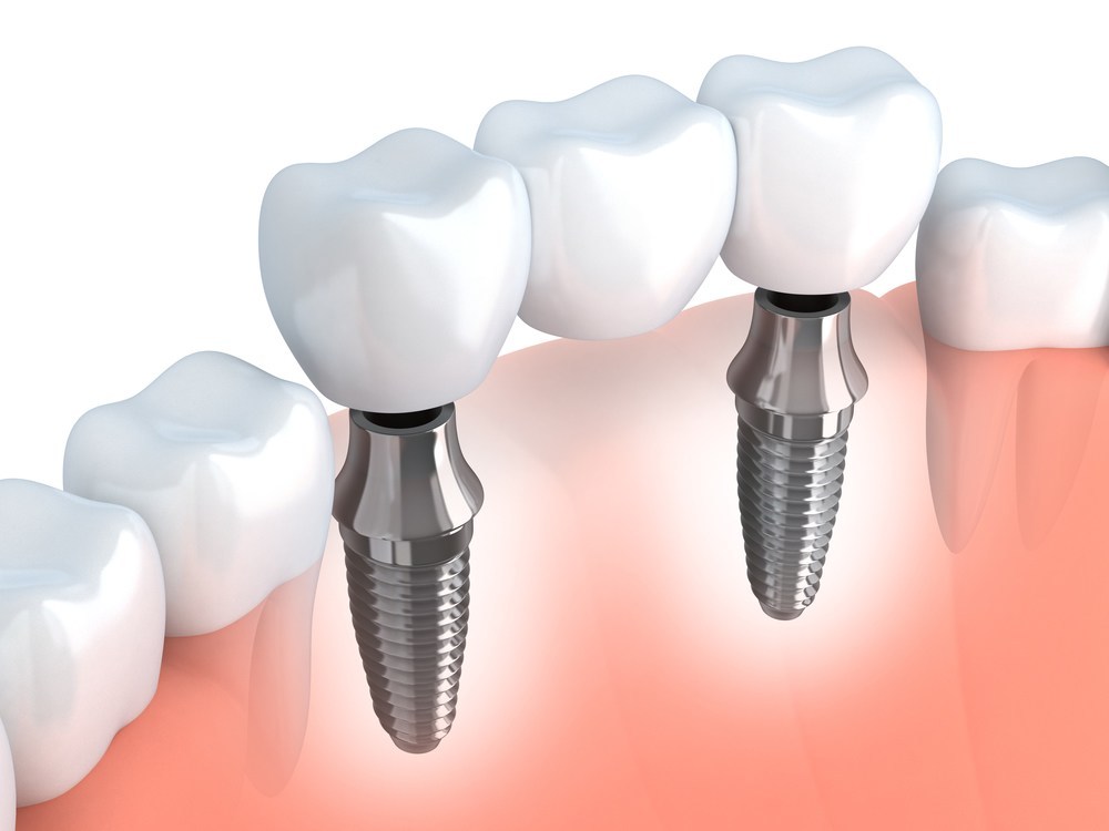 Trường hợp nào nên cấy Implant – Nếu không cấy có ảnh hưởng gì? - Nha khoa Bác sĩ Trung Long Biên