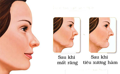 Tiêu xương hàm - Nha khoa Bác sĩ Trung Long Biên