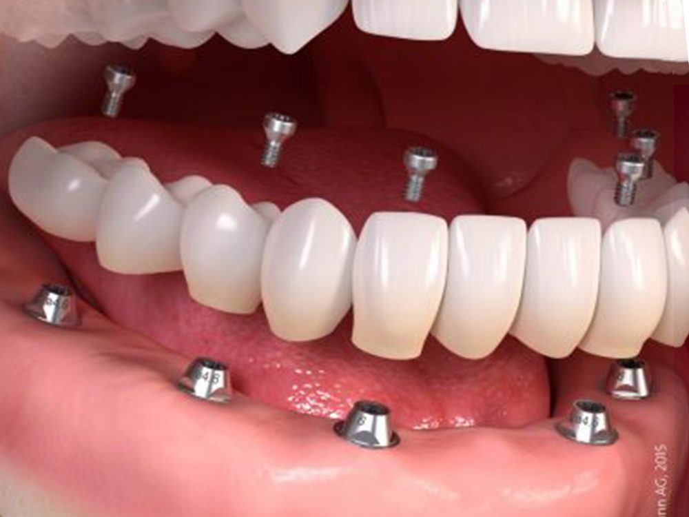 Trường hợp nào nên cấy Implant – Nếu không cấy có ảnh hưởng gì? - Nha khoa Bác sĩ Trung Long Biên