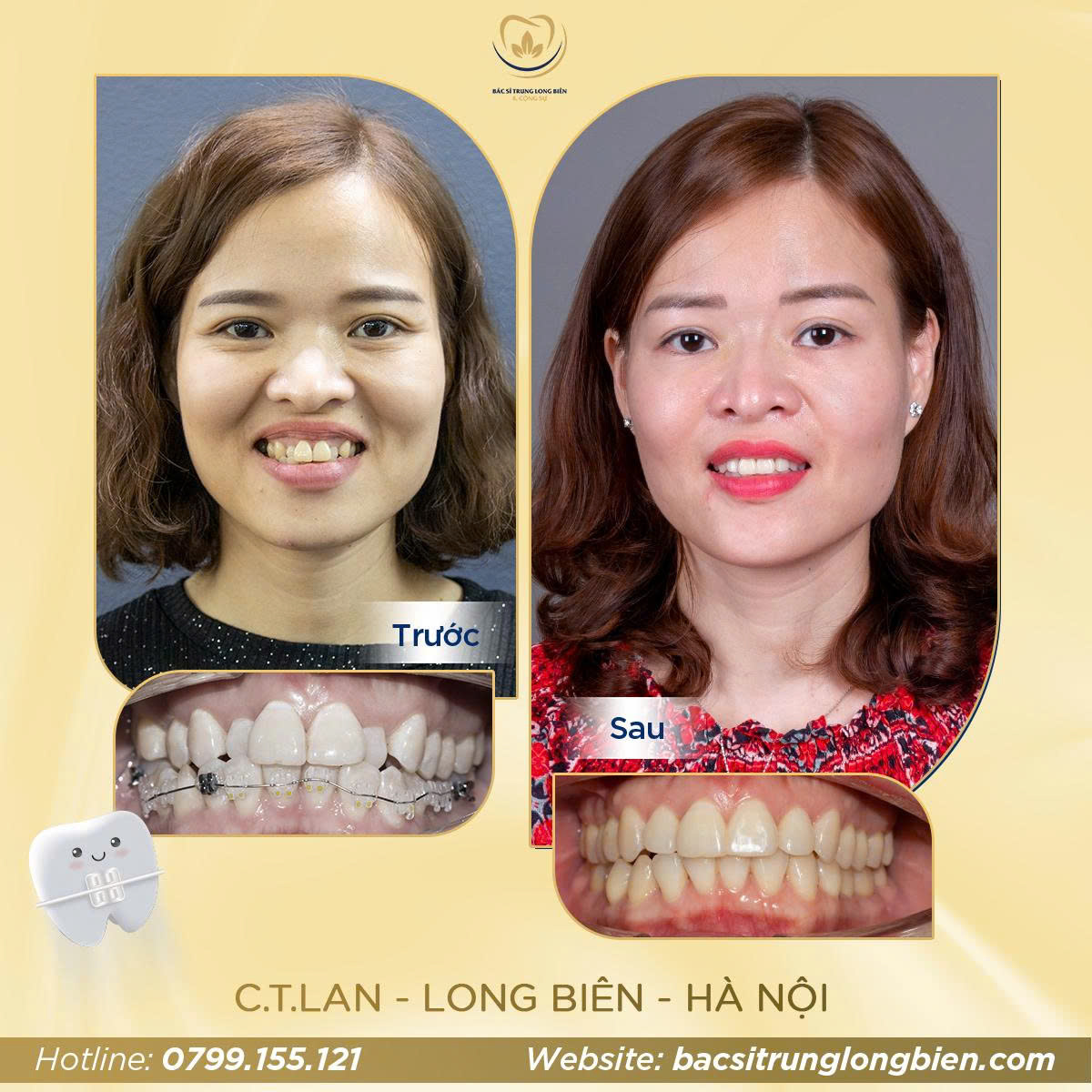 Khách Hàng C.T Lan - Nha khoa Bác sĩ Trung Long Biên
