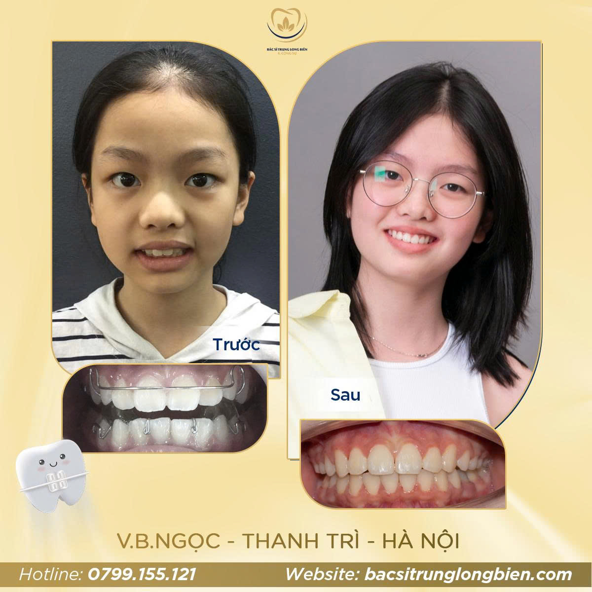 Khách Hàng V.B Ngọc - Nha khoa Bác sĩ Trung Long Biên