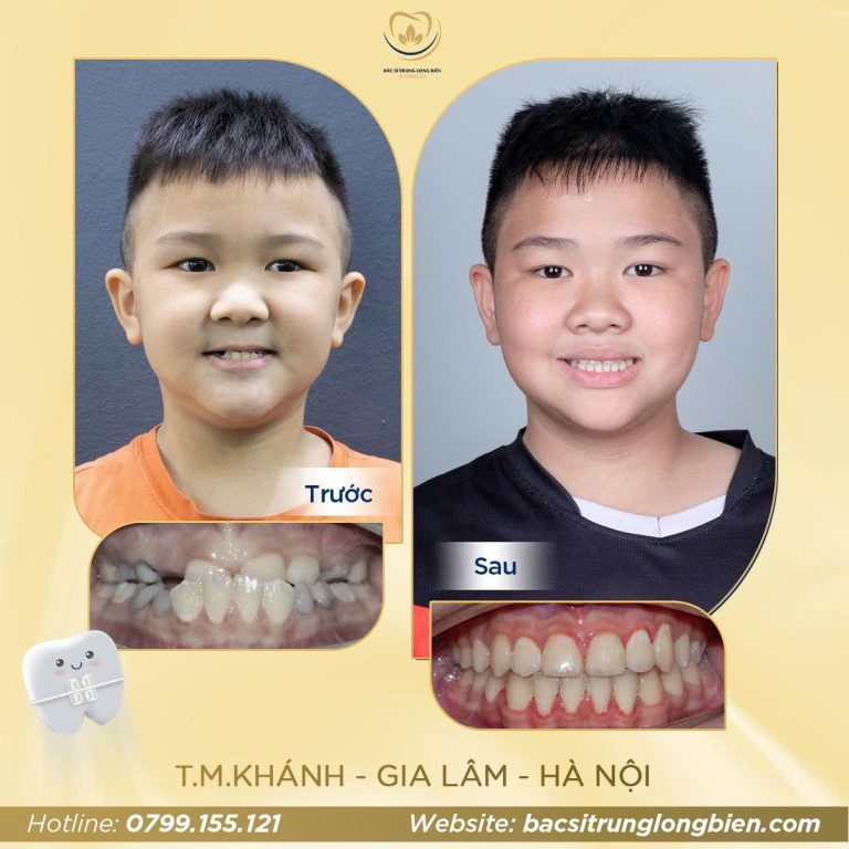 Răng cắn ngược ‑ ảnh trước và sau điều trị tại Nha khoa Bác sĩ Trung Long Biên