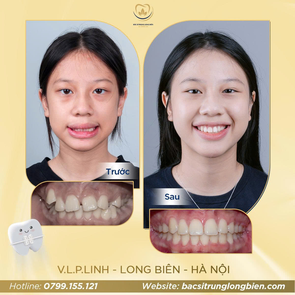 Khách Hàng V.L.P Linh - Nha khoa Bác sĩ Trung Long Biên