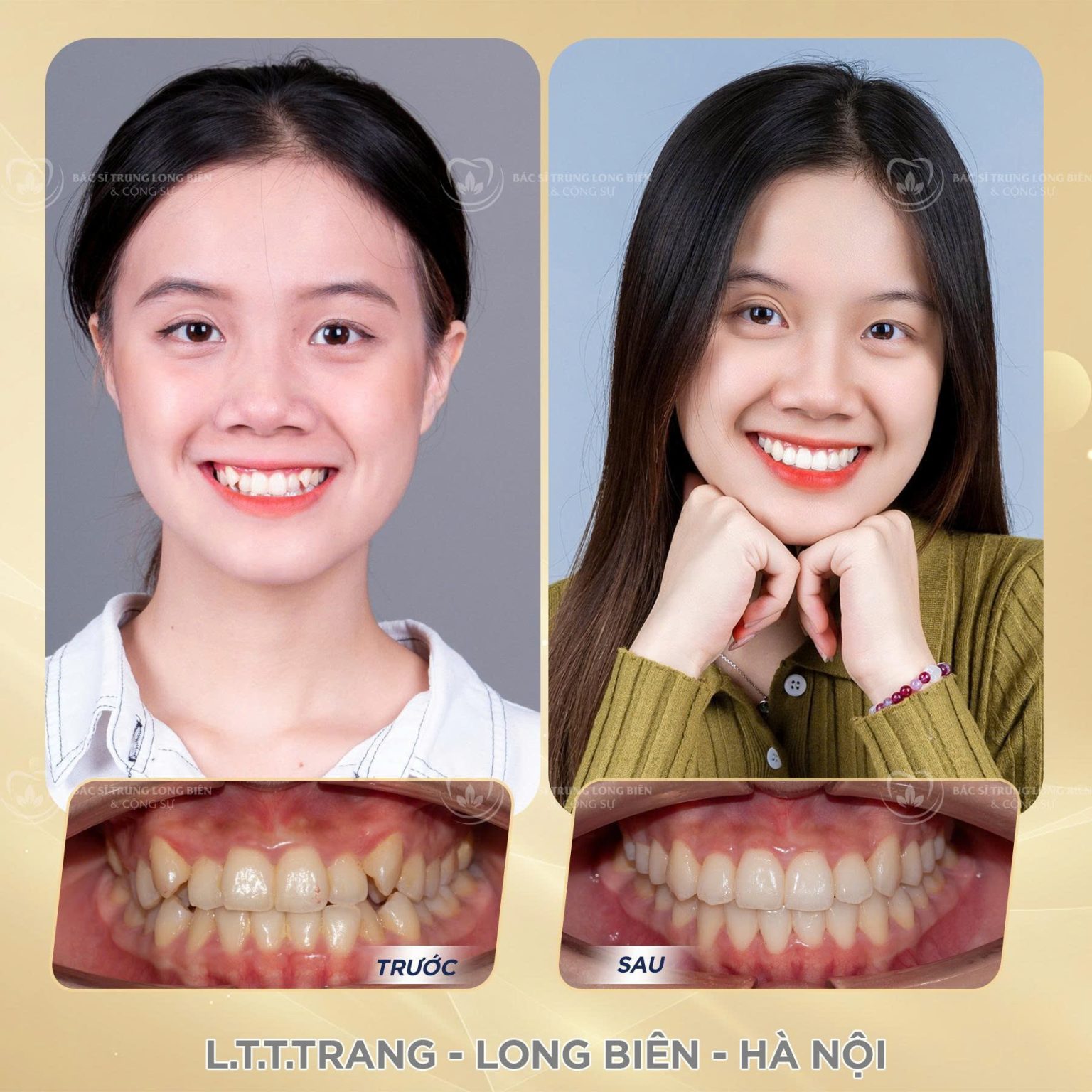 Khách Hàng L.T.T Trang - Nha khoa Bác sĩ Trung Long Biên