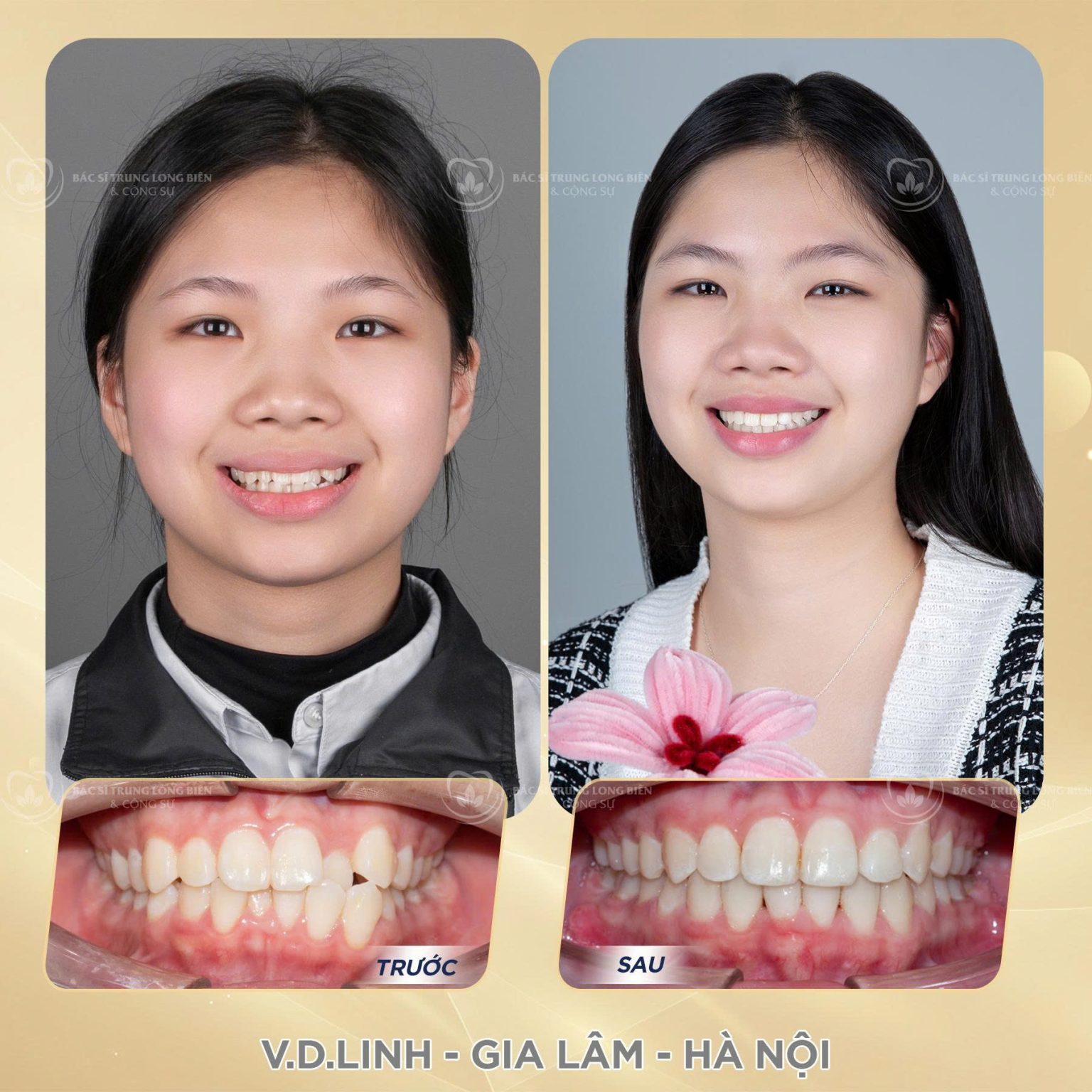 Khách Hàng V.D Linh - Nha khoa Bác sĩ Trung Long Biên
