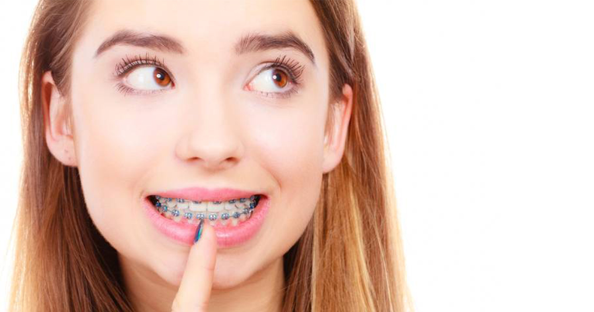 Chỉnh nha là gì? Tại sao chúng ta nên lựa chọn phương pháp chỉnh nha? - Nha khoa Bác sĩ Trung Long Biên