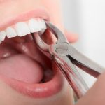 Chăm sóc sau nhổ răng