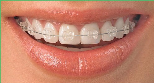 Niềng răng là gì? Niềng răng uy tín ở đâu?