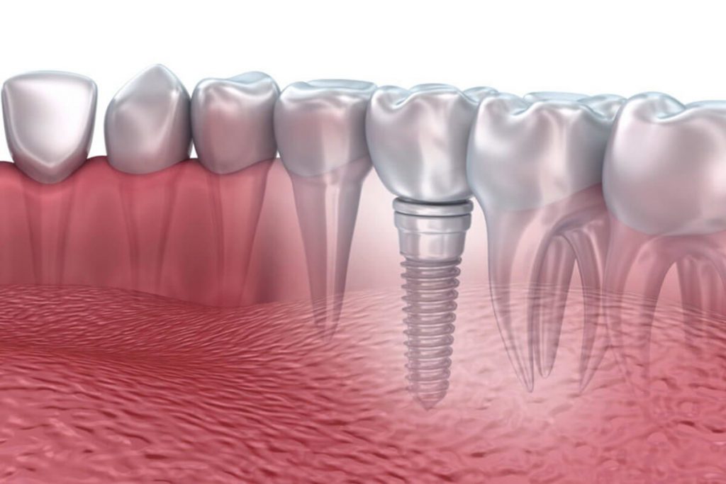 Địa chỉ cấy ghép implant uy tín nhất long biên