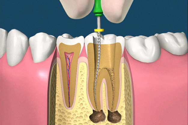 Điều trị tủy