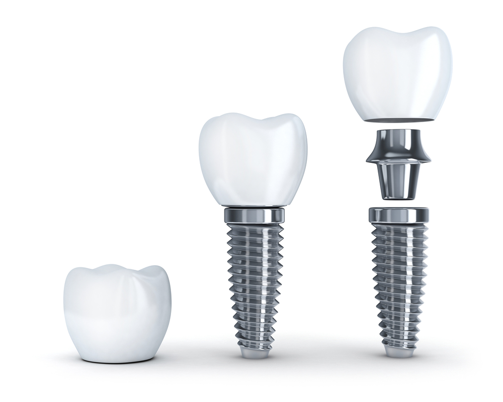 Trường hợp nào nên cấy Implant - Nếu không cấy có ảnh hưởng gì?