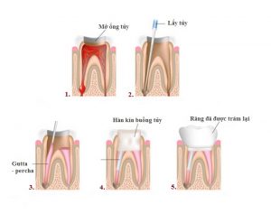 Quy trình điều trị tủy 
