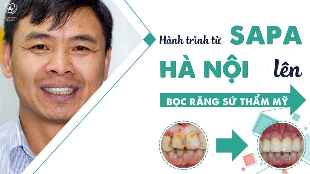 Tham my Rang Katana - Nha khoa Bác sĩ Trung Long Biên