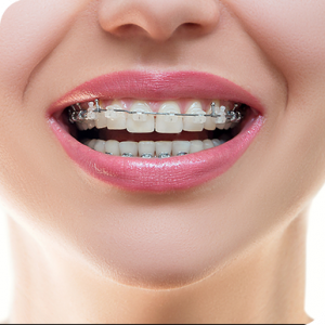 Niềng răng để có nụ cười đẹp – Niềng răng ở đâu là tốt nhất? - Nha khoa Bác sĩ Trung Long Biên