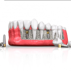 Cách bảo vệ răng Implant – Cách bảo vệ nào là hiệu quả nhất - Nha khoa Bác sĩ Trung Long Biên