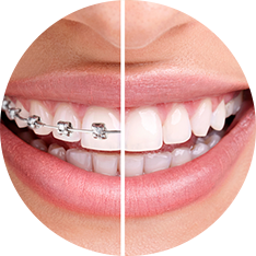 Kết thúc niềng răng - Nha khoa Bác sĩ Trung Long Biên
