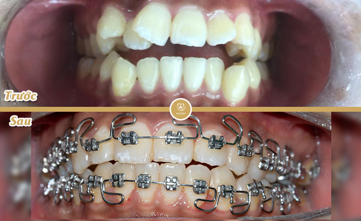 Chỉnh nha là gì? Tại sao chúng ta nên lựa chọn phương pháp chỉnh nha? - Nha khoa Bác sĩ Trung Long Biên