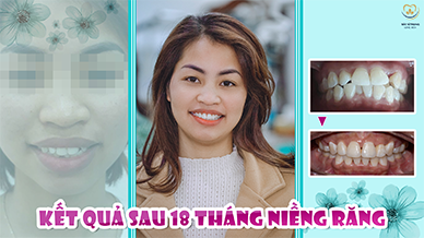 Video Khách hàng Tuyết - Nha khoa Bác sĩ Trung Long Biên