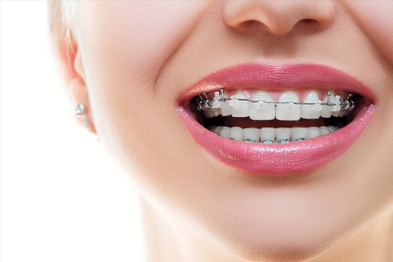 Chỉnh nha mắc cài - Người niềng không đọc bài viết này sẽ hối hận