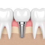 Chăm sóc răng Implant: ăn gì, vệ sinh và điều cần tránh