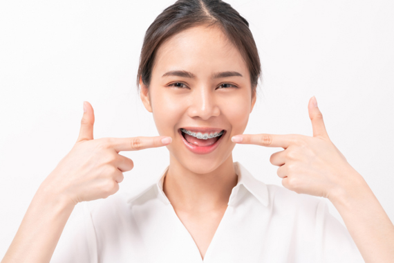 Niềng răng để có nụ cười đẹp - Niềng răng ở đâu là tốt nhất?