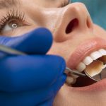Trám bít hố rãnh: giải pháp dự phòng sâu răng cho răng hàm của trẻ