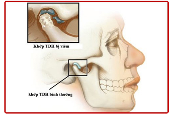 Rối loạn khớp thái dương hàm - Triệu chứng và phương pháp điều trị!