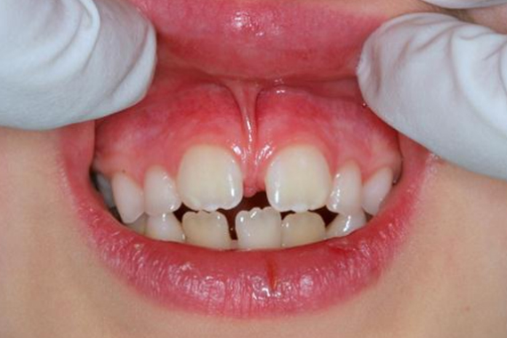 Phanh môi là gì? Những kiến thức cơ bản và phương pháp điều trị!
