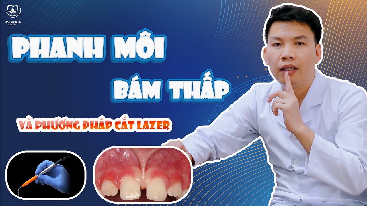 Phanh môi là gì? Những kiến thức cơ bản và phương pháp điều trị! - Nha khoa Bác sĩ Trung Long Biên