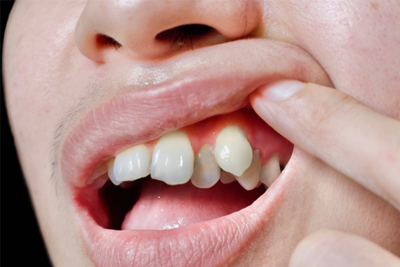 Bọc sứ và niềng răng - Lựa chọn phương pháp nào là tốt nhất