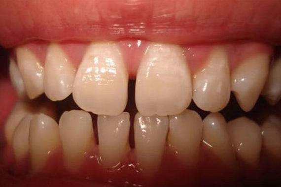 Răng thưa – Nguyên nhân, giải pháp và cách khắc phục hiệu quả - Nha khoa Bác sĩ Trung Long Biên