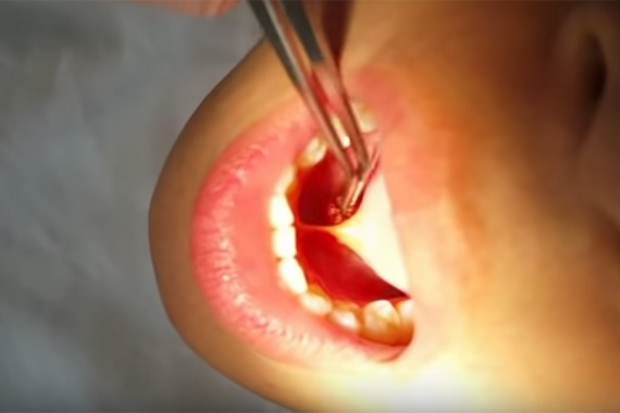 Chăm sóc trẻ sau cắt thắng lưỡi - Đừng bỏ qua nếu không muốn hối hận!