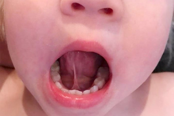 Dính thắng lưỡi – Những ảnh hưởng và cách điều trị như thế nào? - Nha khoa Bác sĩ Trung Long Biên