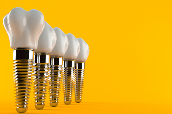 Dịch vụ Implant tại nha khoa Bác sĩ Trung Long Biên có gì “hót”? - Nha khoa Bác sĩ Trung Long Biên
