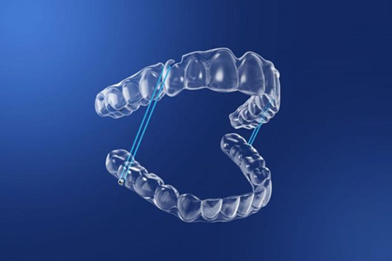 Niềng răng - Phương pháp nào phù hợp nhất cho trẻ em &amp; Tại sao?