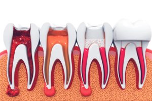 Điều trị tủy răng 1 lần hẹn tại nha khoa bác sĩ Trung Long Biên - Nha khoa Bác sĩ Trung Long Biên