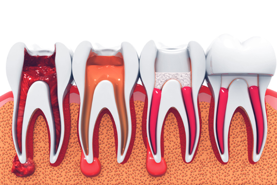 Điều trị tủy răng 1 lần hẹn tại nha khoa bác sĩ Trung Long Biên - Nha khoa Bác sĩ Trung Long Biên
