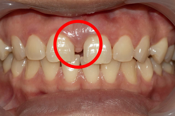 Phanh môi là gì? Những tác hại của tình trạng phanh môi bám thấp!