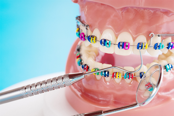 Trẻ niềng răng - Những thuận lợi và khó khăn khi trẻ nhỏ niềng răng?