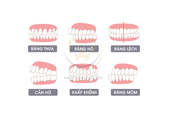 Trường hợp niềng răng ở trẻ - Có răng sữa có niềng được không?