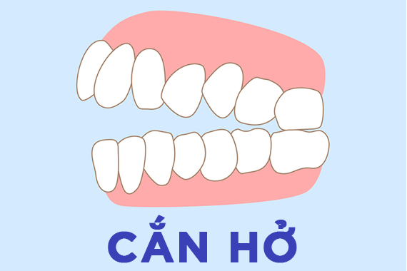 Khớp cắn hở - Biểu hiện, nguyên nhân và phương pháp điều trị!