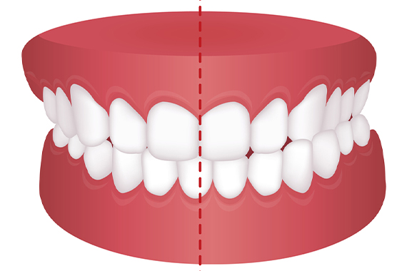 Khớp cắn chéo là gì? Nguyên nhân & Phương pháp điều trị tình trạng!